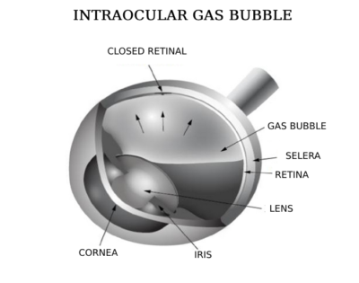 Intraocular Gas Bubble | Image of Eye Disease