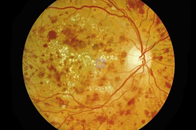 Severe Non-Proliferative Retinopathy | Close Up Image of Retina