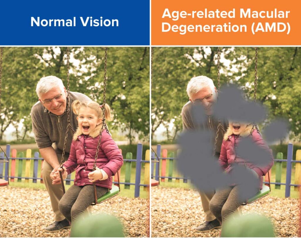 Syfovre Dry Macular Degeneration Treatment in Sarasota, Bradenton