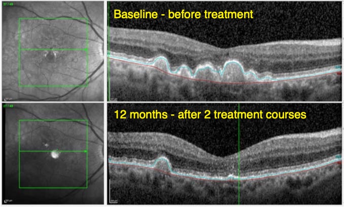 Example of Drusen Change with Valeda Dry Macular Degeneration Treatment