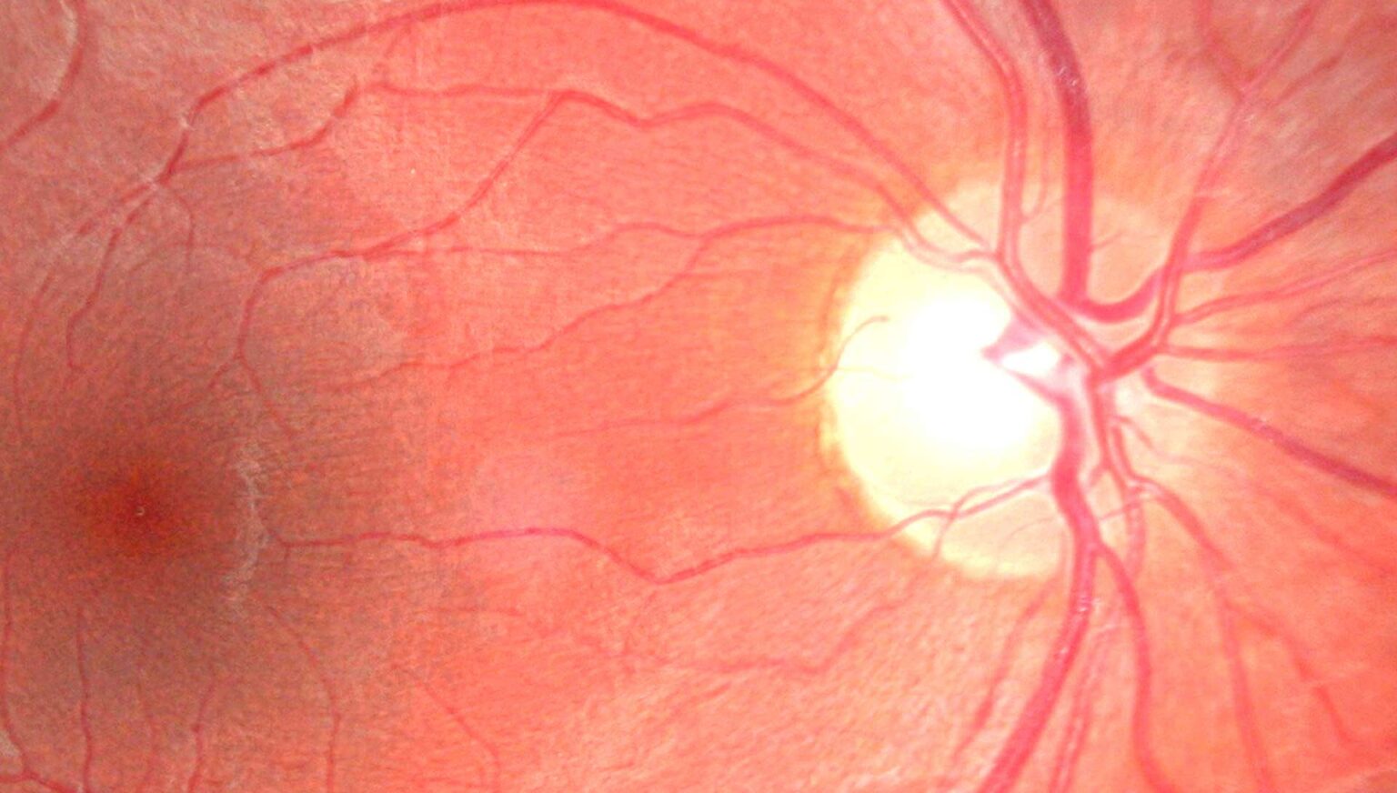 Retina Care Archives - Shane Retina