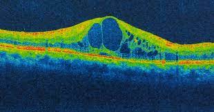 What is Cystoid Macular Edema? | Thermal Image of Eye Condition