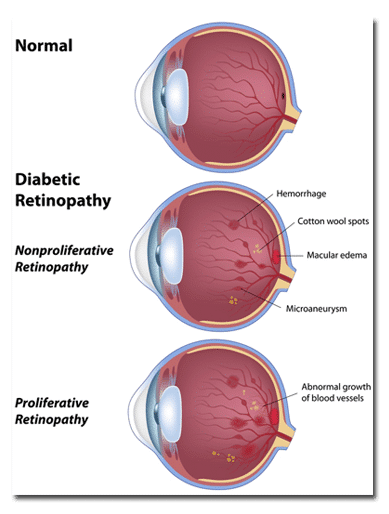 Diabetic Retinopathy Anatomy Graphic