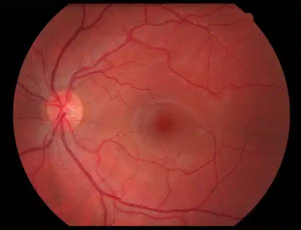 Patient Services and Education 1 diabetic retinopathy