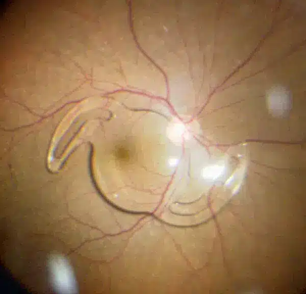 Patient Services and Education 3 Dislocated Intraocular Lens
