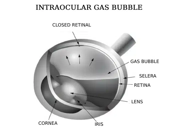 Macular Hole 1 Intraocular Gas Bubble | Image of Eye Disease