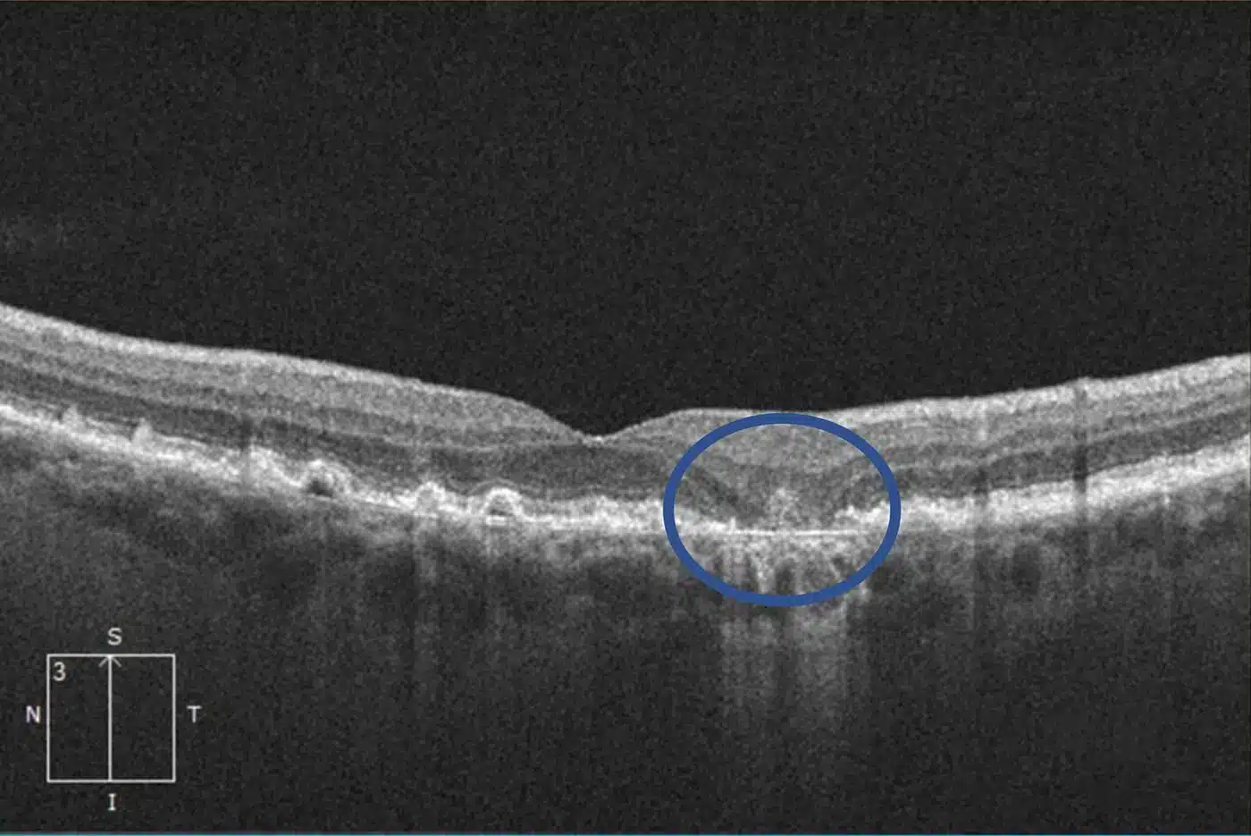 Syfovre Injections 5 Retinal atrophy causing a blind spot near the central vision in Macular Degeneration.