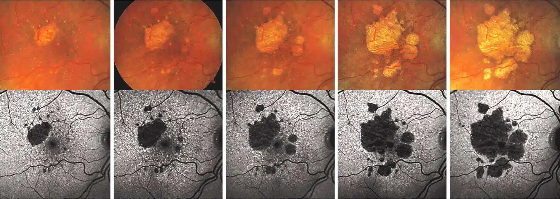 Syfovre Injections 3 Progression of dry macular degeneration. With advanced dry macular degeneration, retinal atrophy leads to blind spots in the central vision that enlarge over time