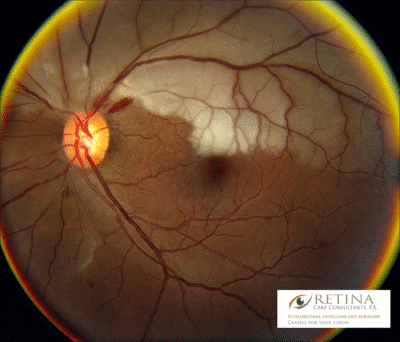 Retinal Artery Occlusion Spcialist in Sarasota Florida
