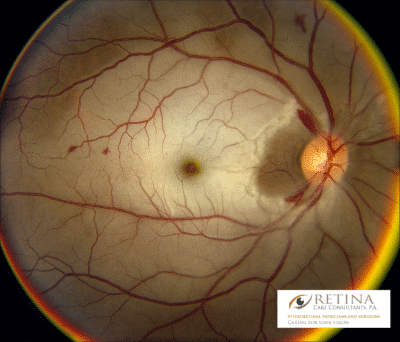 Retinal Artery Occlusion Spcialist in Sarasota Florida