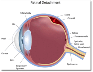 Detached Retina Specialist in Sarasota Florida