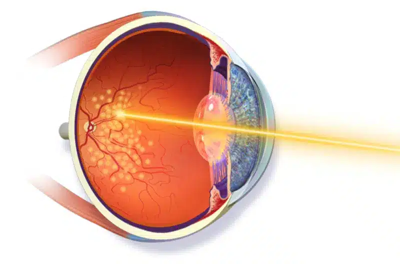 Patient Services and Education 4 Retinal Laser