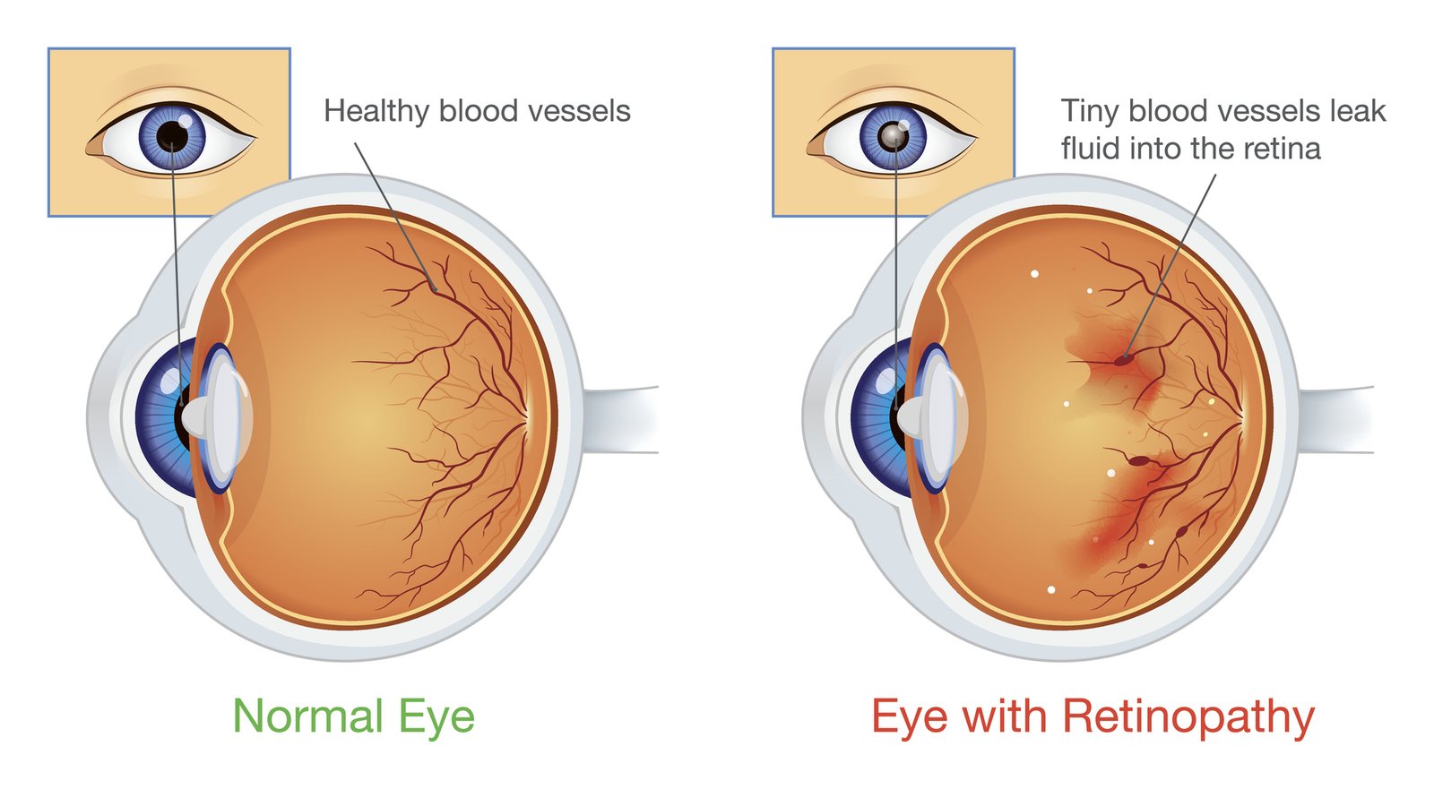 Illustration comparing a normal eye with an eye with diabetic retinopathy in which tiny blood vessels leak fluid into the retina.