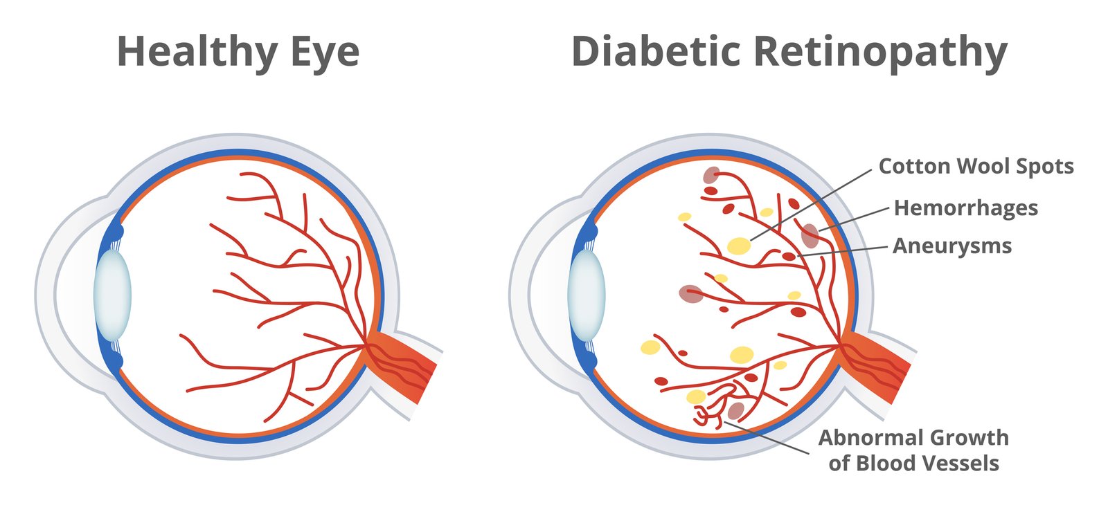 Diagram of a healthy eye next to an eye with diabetic retinopathy, labeling cotton wool spots, hemorrhages, aneurysms, and abnormal growth of blood vessels.