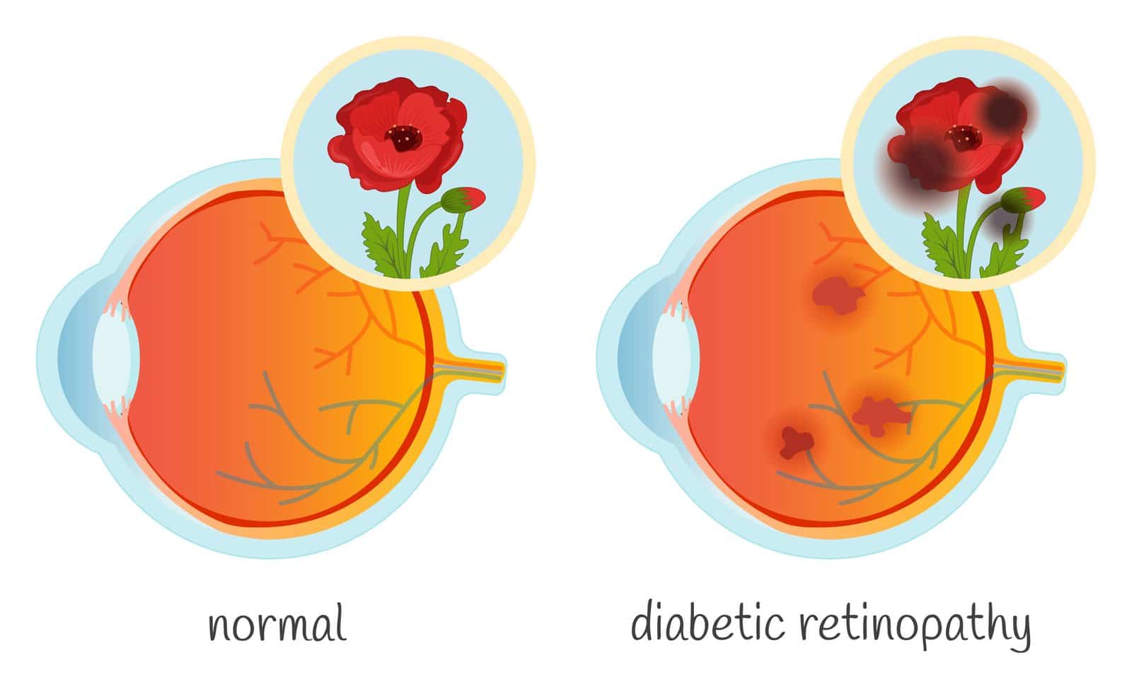 Illustration of a normal eye and an eye with diabetic retinopathy, each with an inset showing how a red flower looks: clear on the left, blotched with dark patches on the right.