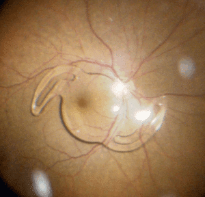 dislocated lens implant sarasota bradenton venice fl