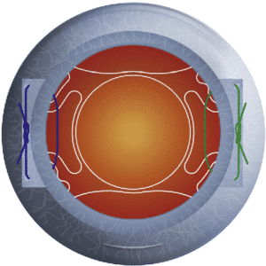 Sutured IOL | Image of a sutured IOL