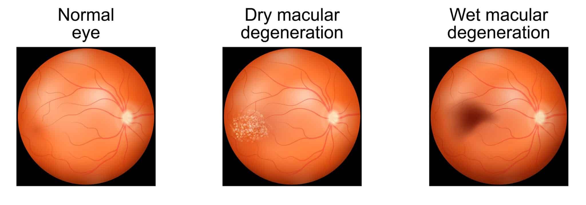 Three views of the retina: a normal retina, dry macular degeneration with pale drusen deposits, and wet macular degeneration with dark bleeding under the retina.