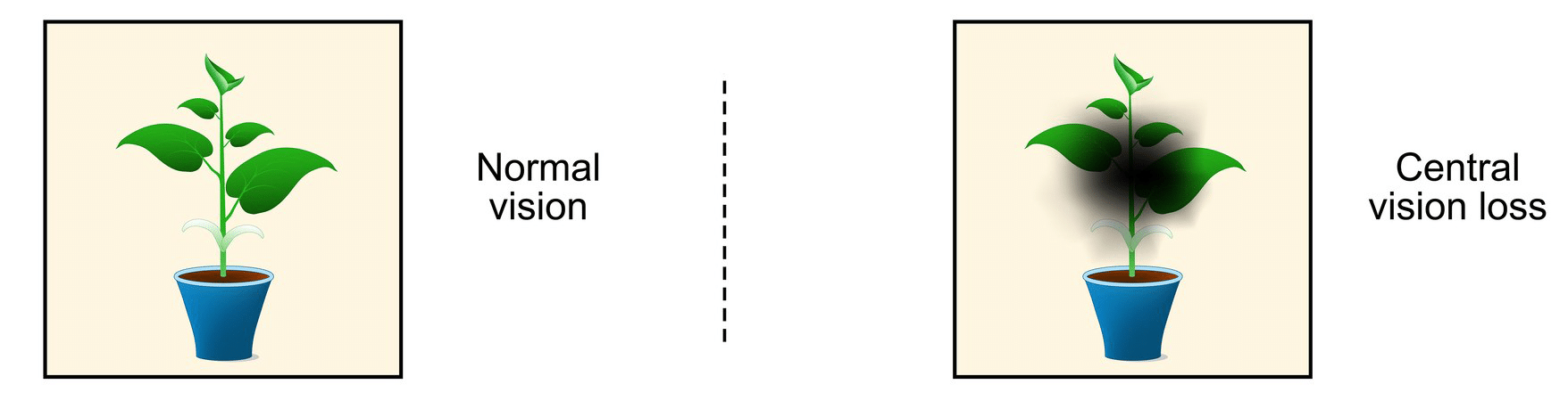 Two views of a potted plant, one clear and one with a dark blur in the center, showing normal vision and central vision loss.