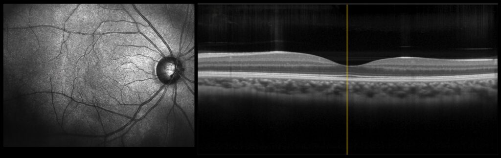 OCT scan showing a photo of the retina and a cross-section of a healthy macula with a normal central dip at the fovea.