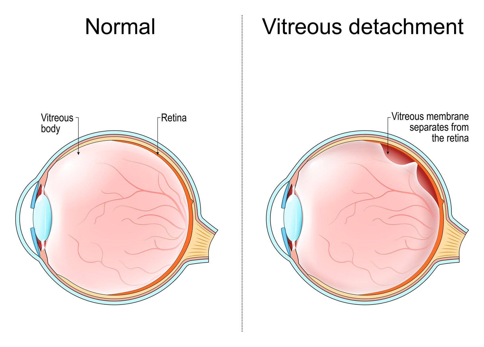 Illustration comparing a normal eye with an eye in which the vitreous membrane has separated from the retina.