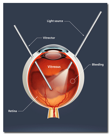 Vitrectomy Surgery | Ophthalmologists Eye Anatomy Diagram