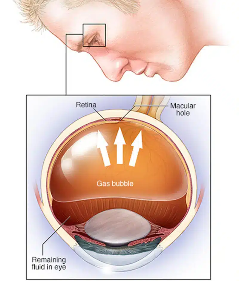 Patient Services and Education 5 retinal detachment surgery pneumatic retinopexy