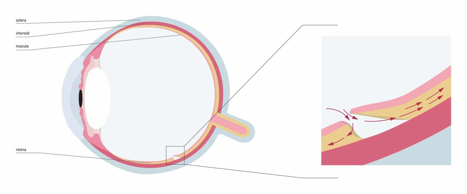 Diagram of the eye with an enlarged inset showing fluid passing through a retinal tear and spreading under the retina.