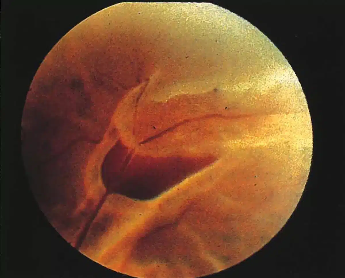 Retinal Tear Treatment 1 retinal tear treatment in sarasota florida