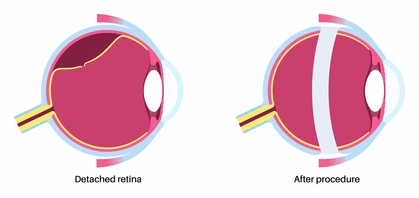 Illustration of an eye with a detached retina beside the same eye after a scleral buckle procedure, with a band around the outside of the eye.